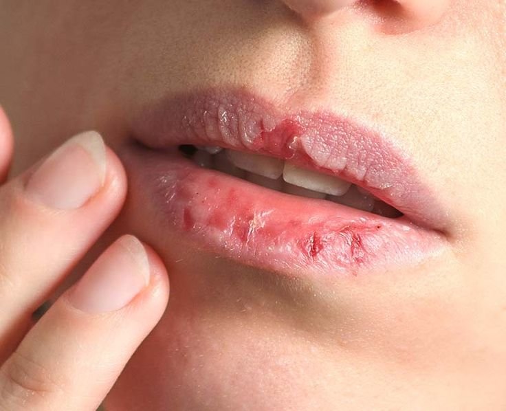 The Ultimate Guide To Dealing With Dry Skin In Cold Climates 2 cold climate